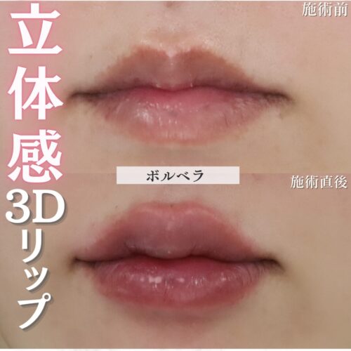 唇　ヒアルロン酸注入　症例